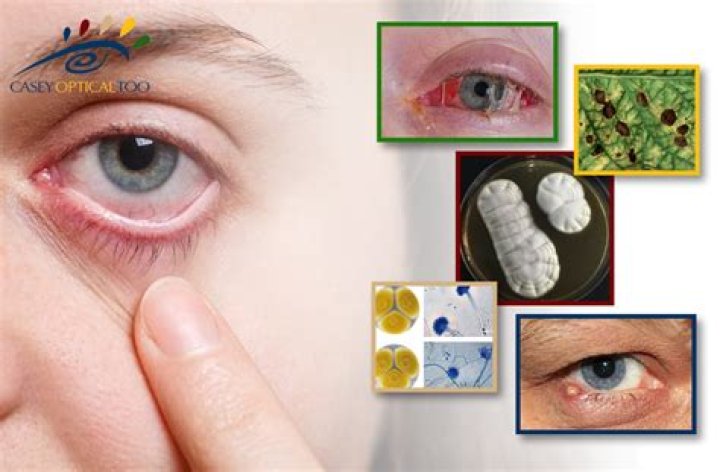 What eye infections does gentamicin treat?