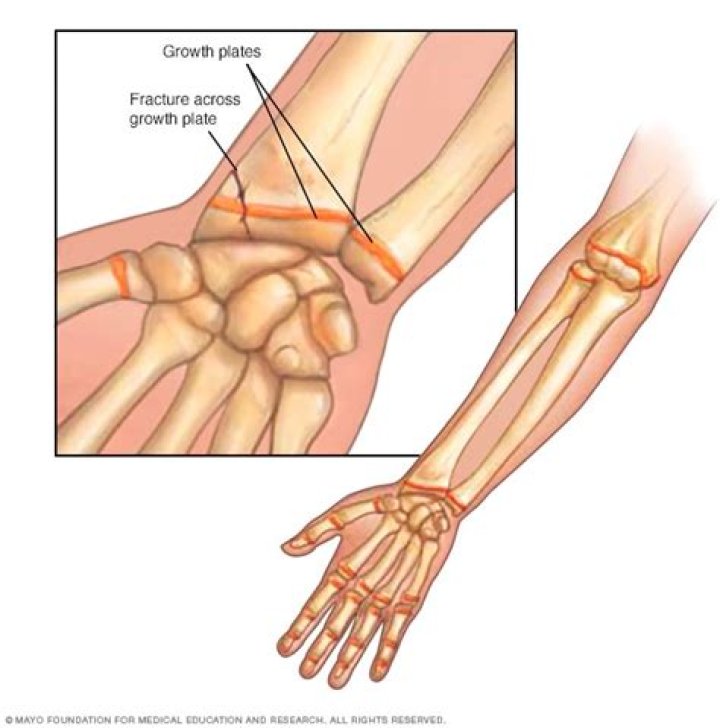 What fracture affects the growth plate?