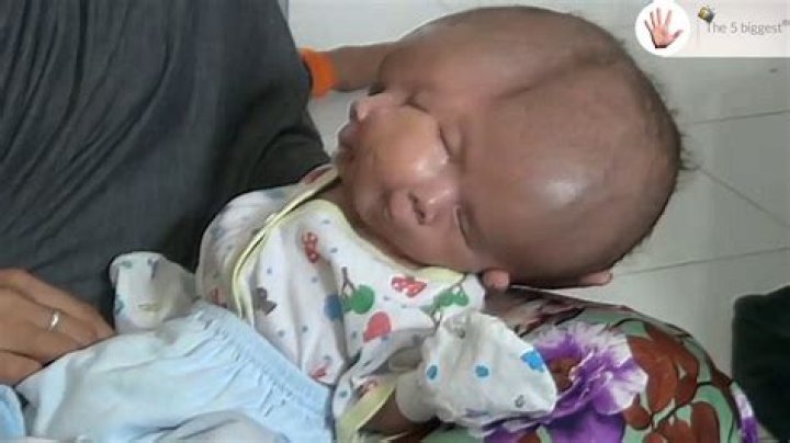 What Happened to baby with 2 faces?