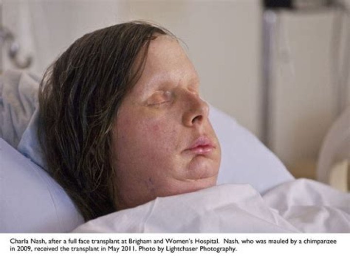 What happened to the lady that had a face transplant?