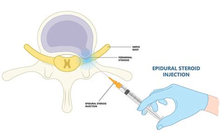 What happens after a transforaminal epidural steroid injection?