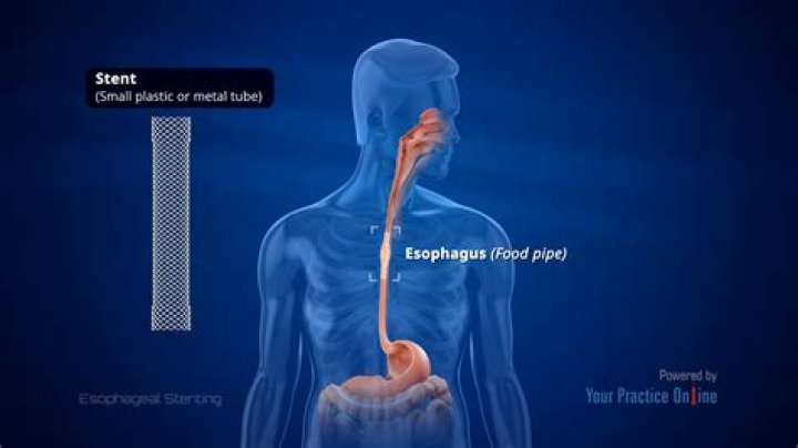 What happens during an Esophagram?