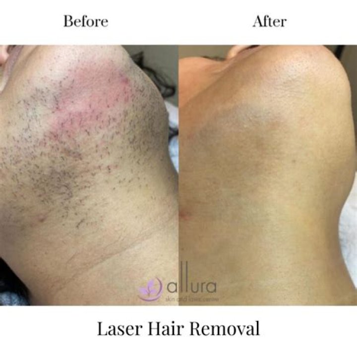 What happens if you stop laser hair removal after 3 sessions?