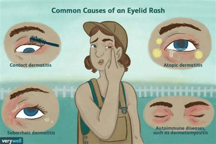 What helps swollen itchy eyelids?