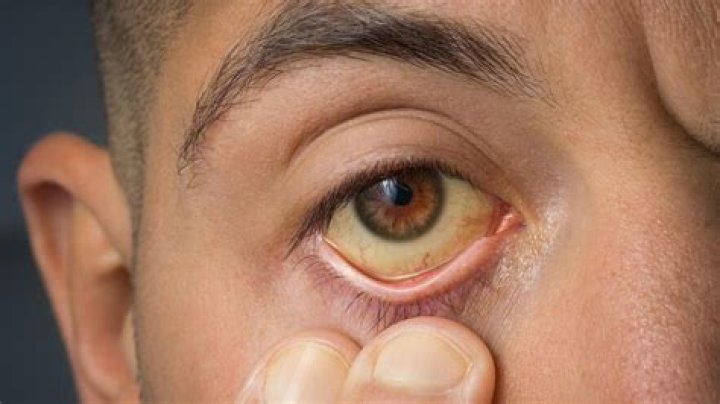What illness makes your eyes yellow?