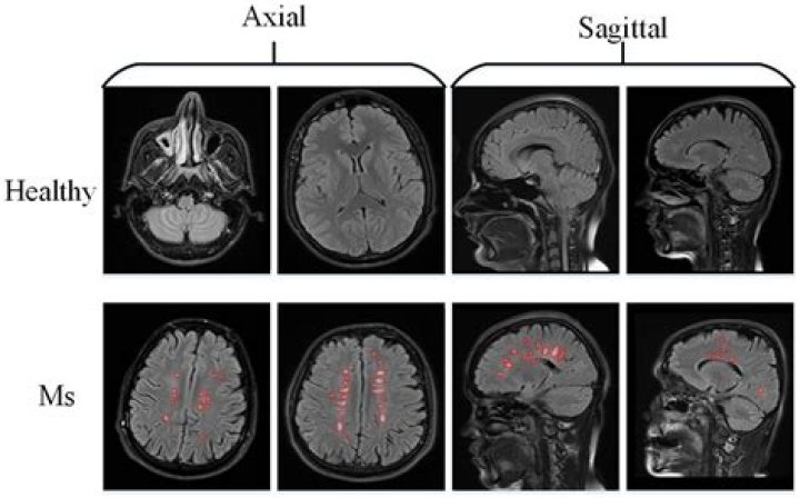 What indicates possible MS during an MRI?