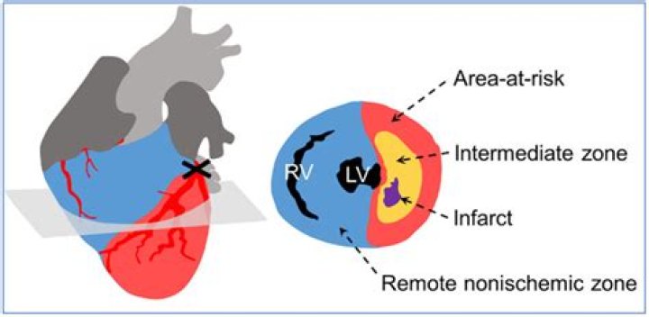 What is a border zone infarct?