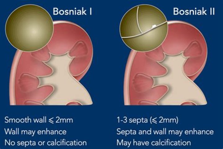 What is a Bosniak type 4 cyst?