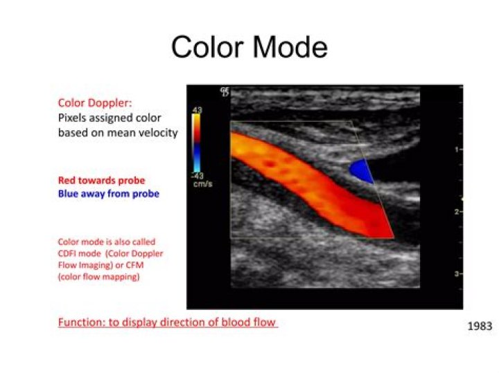 What is a color flow mapping ultrasound?