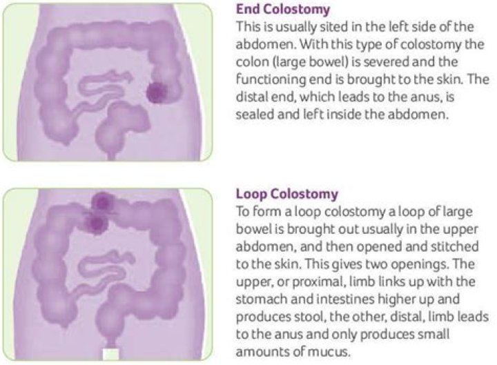 What is a Colorectostomy?