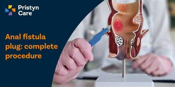 What is a fistula plug made of?