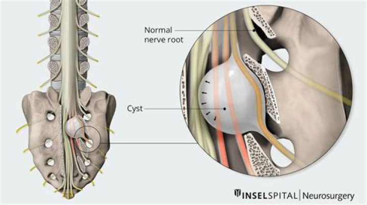 What is a nerve root sleeve cyst?