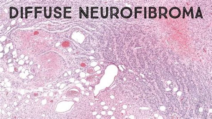 What is a Neurofibrosarcoma?