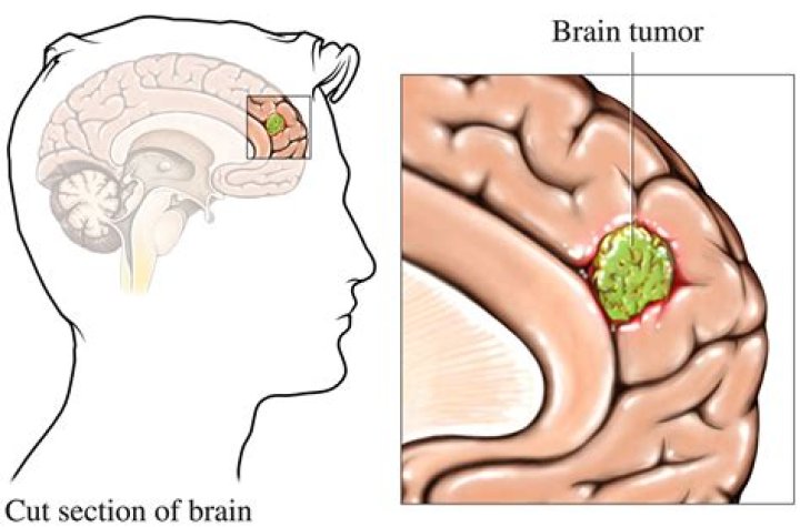What is a non cancerous tumor in the brain called?