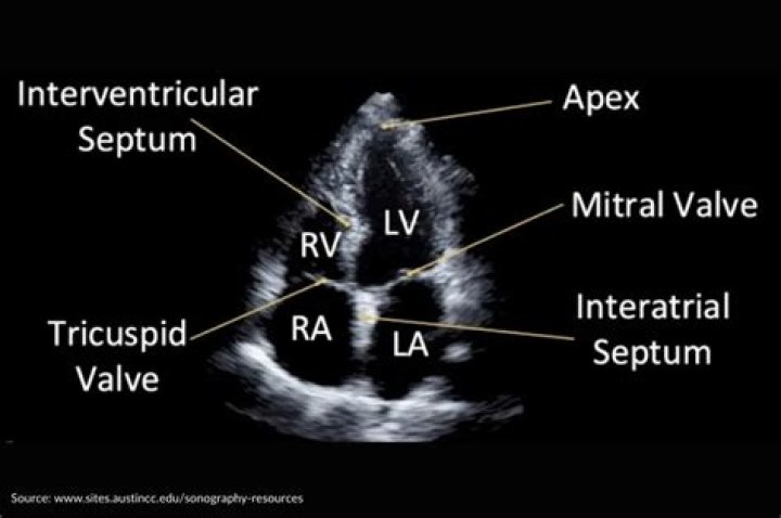 What is a normal echo result?