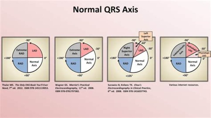 What is a normal T axis?