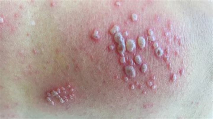 What is a rash that looks like blisters?
