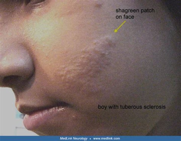 What is a shagreen patch?