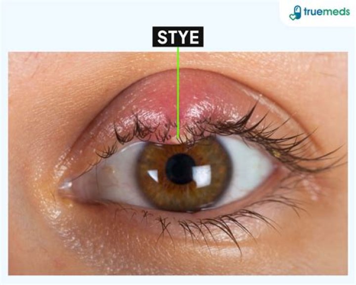 What is a stye usually caused by?