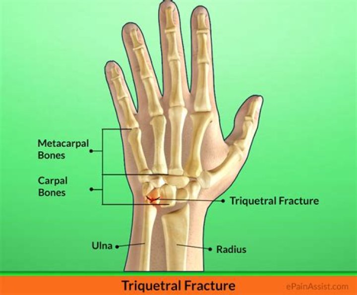 What is a triquetrum fracture?