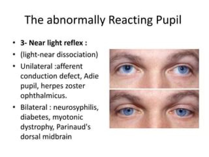 What is an abnormal pupillary response?