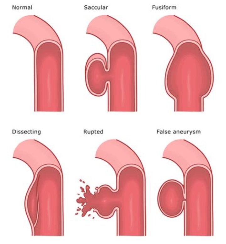What is an aneurysmal dilatation?