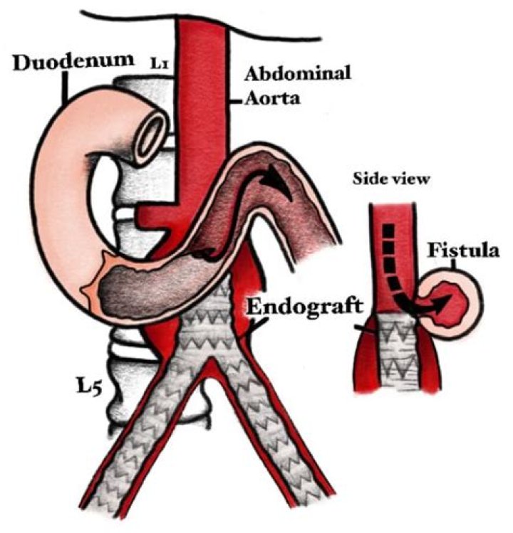 What is an aorto bi iliac endograft?