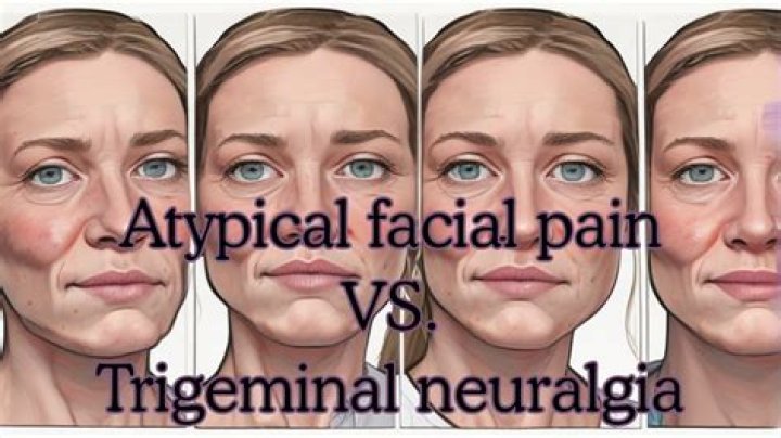 What is atypical headache?