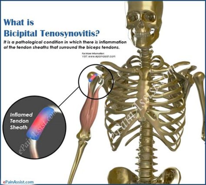 What is Bicipital tenosynovitis?