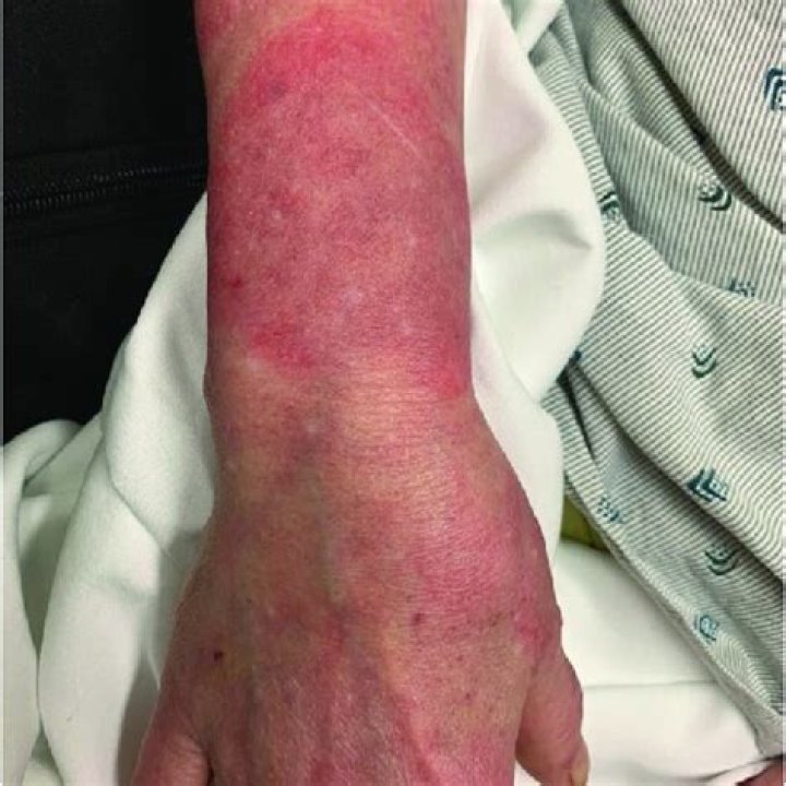 What is central clearing rash?
