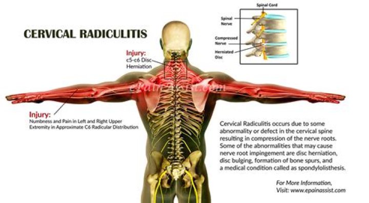 What is cervical Radiculitis?