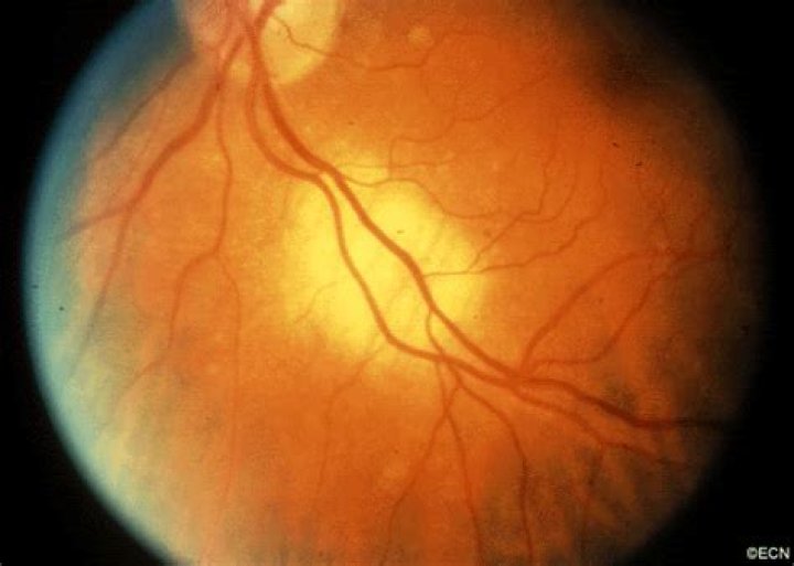What is choroidal metastasis?
