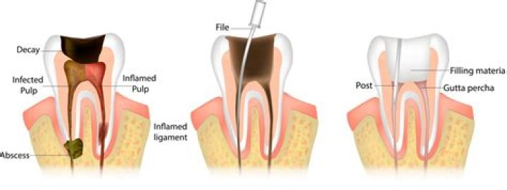 What is considered Endo?