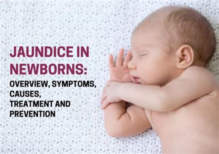 What is considered high level of jaundice in newborns?