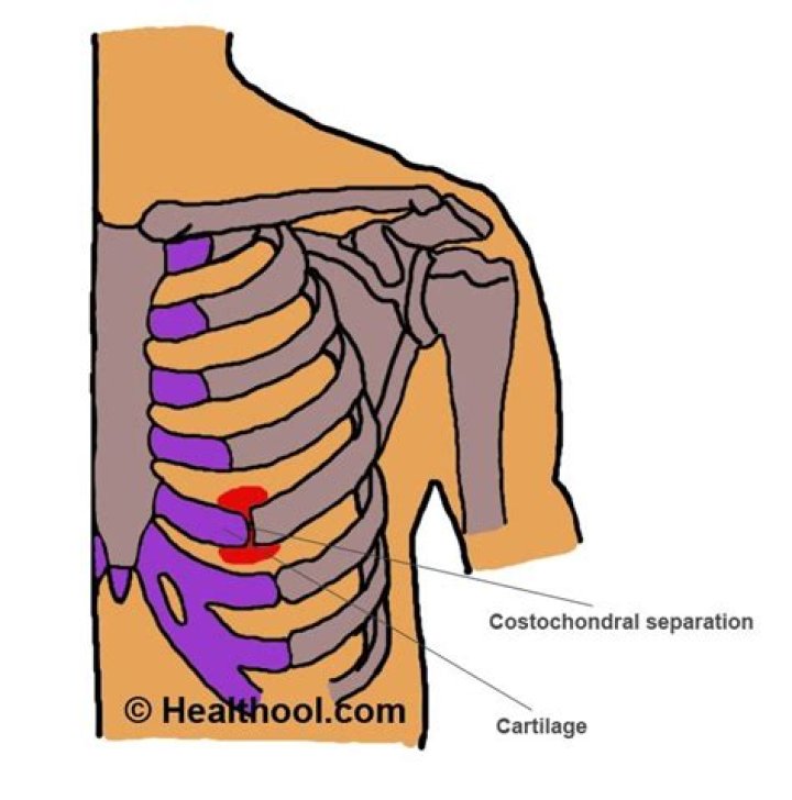 What is costochondral separation and how is it treated?