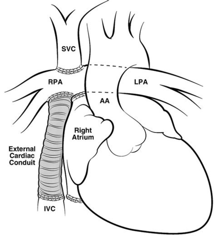 What is Extracardiac shunting?