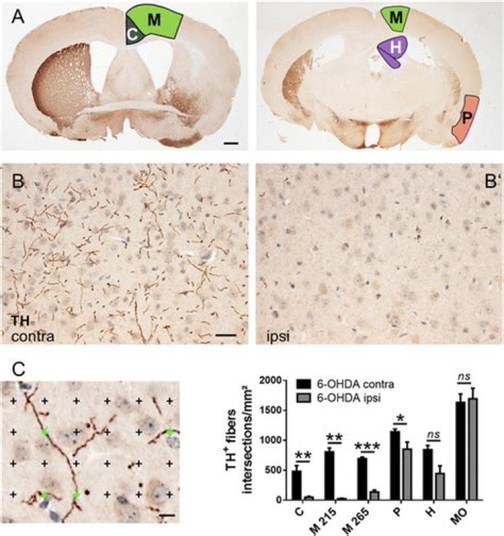 What is Extrastriatal?