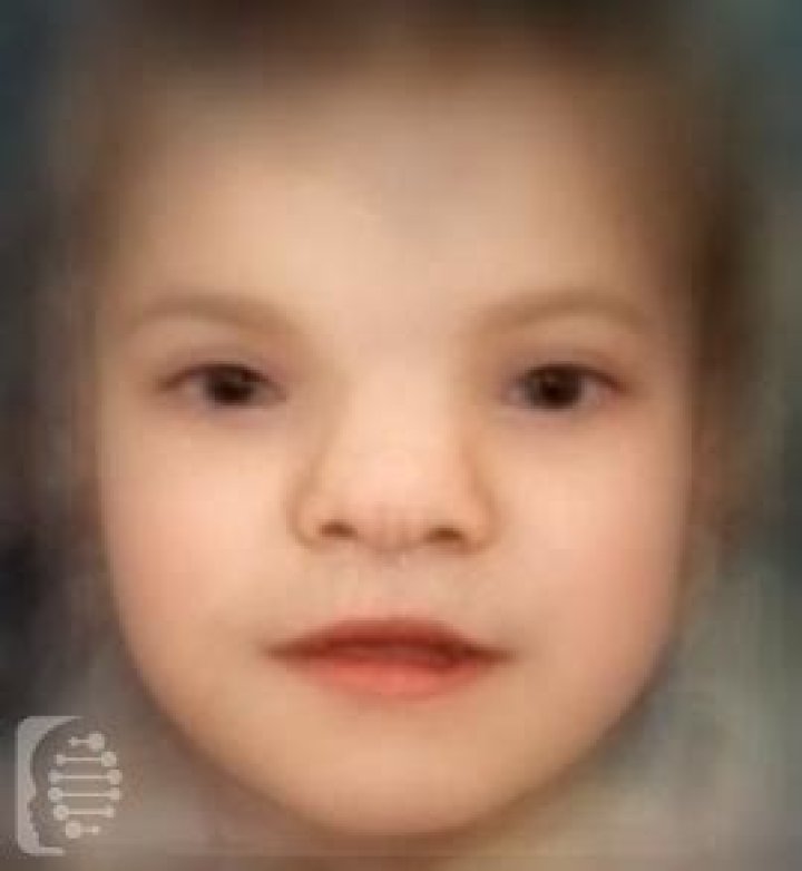 What is frontonasal dysplasia?