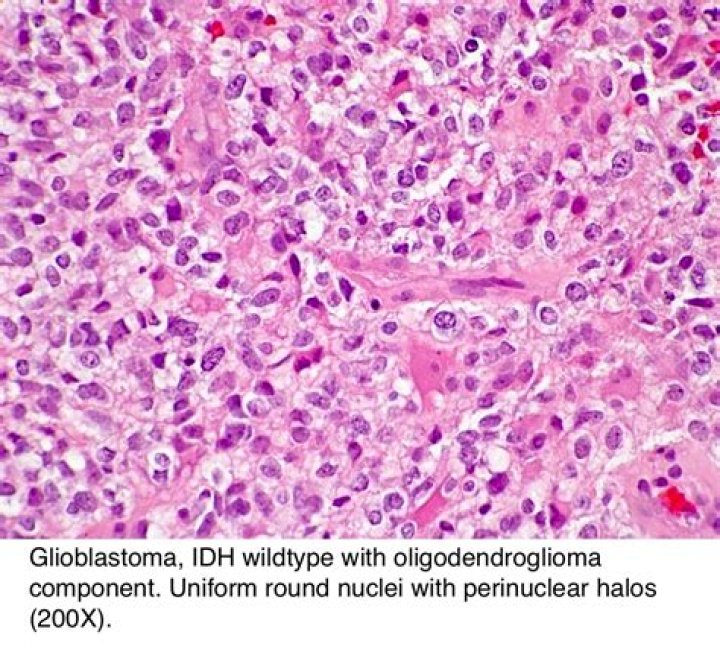 What is glioblastoma IDH mutant?