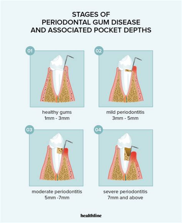 What is gum pocketing?
