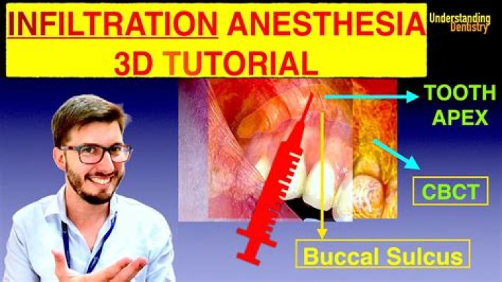 What is infiltrative anesthesia?