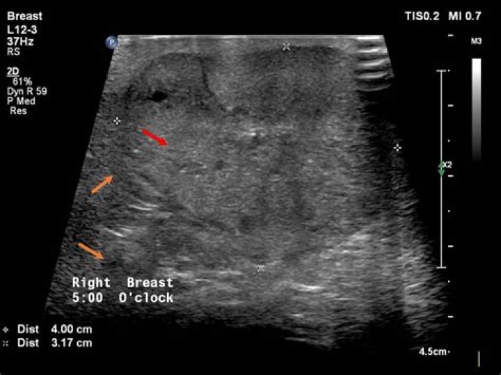 What is Isoechoic myoma?