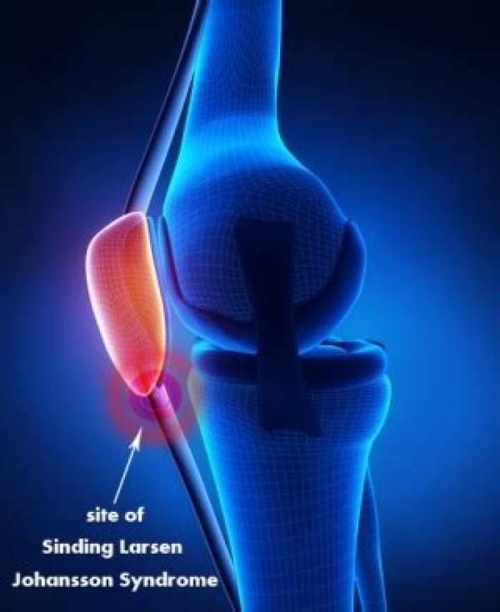 What is Larsen Johansson syndrome?