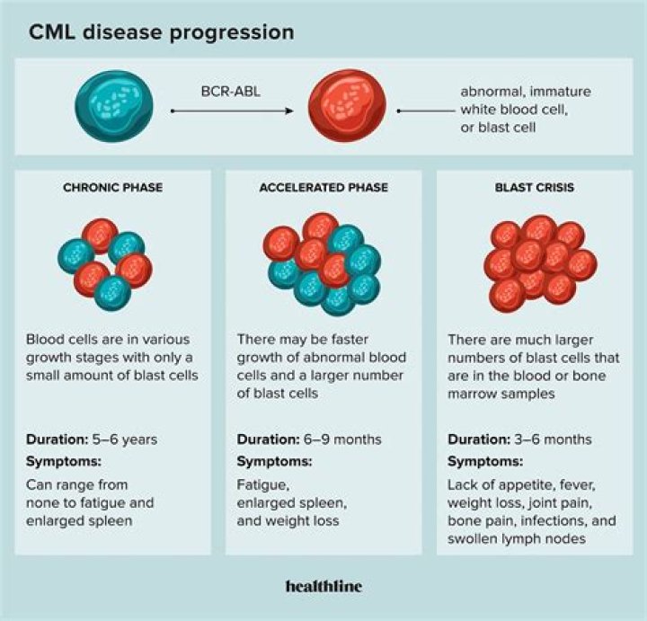 What is leukemia blast crisis?