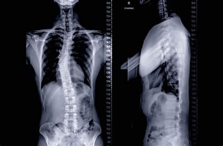 What is malalignment syndrome?