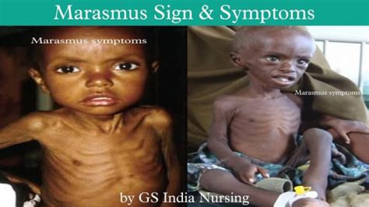 What is marasmus syndrome?