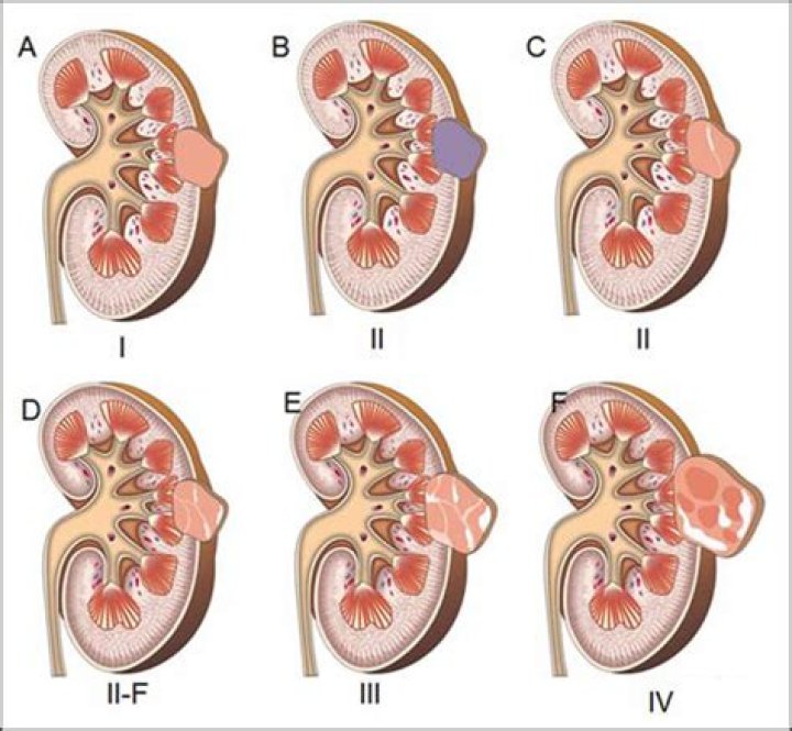 What is meant by cortical cyst in left kidney?