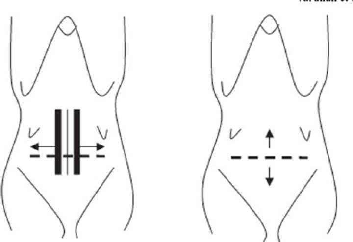 What is Misgav Ladach technique?