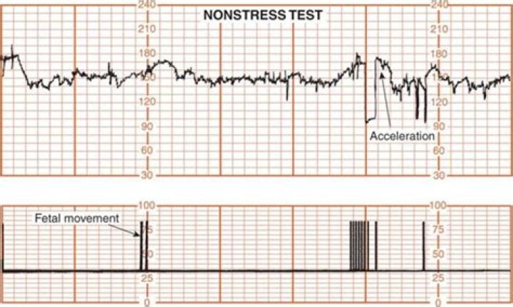 What is non-reassuring fetal status?