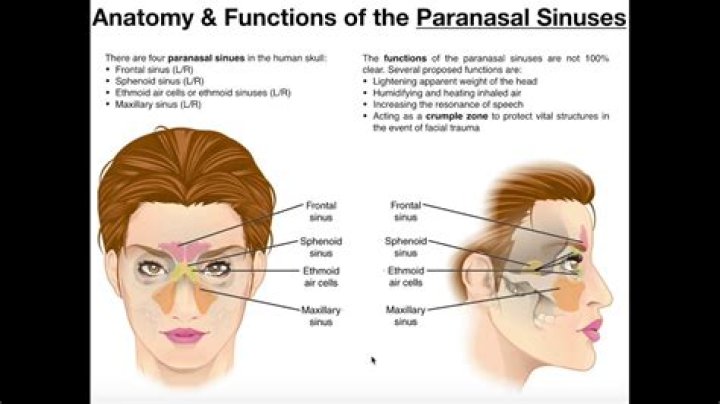 What is Parasinus?